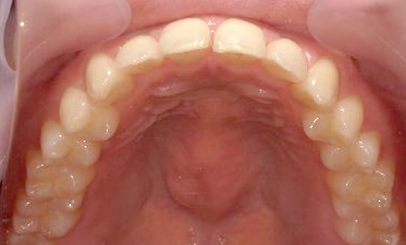 部分矯正すきっ歯の症例写真