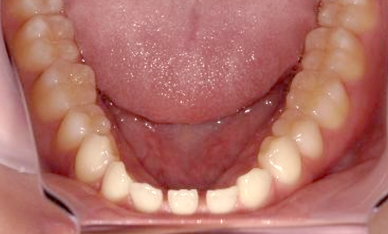 部分矯正すきっ歯の症例写真