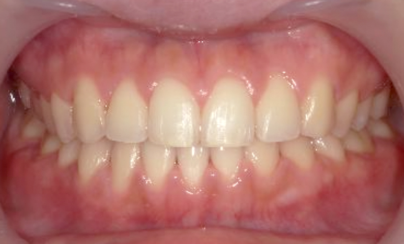 部分矯正すきっ歯の症例写真