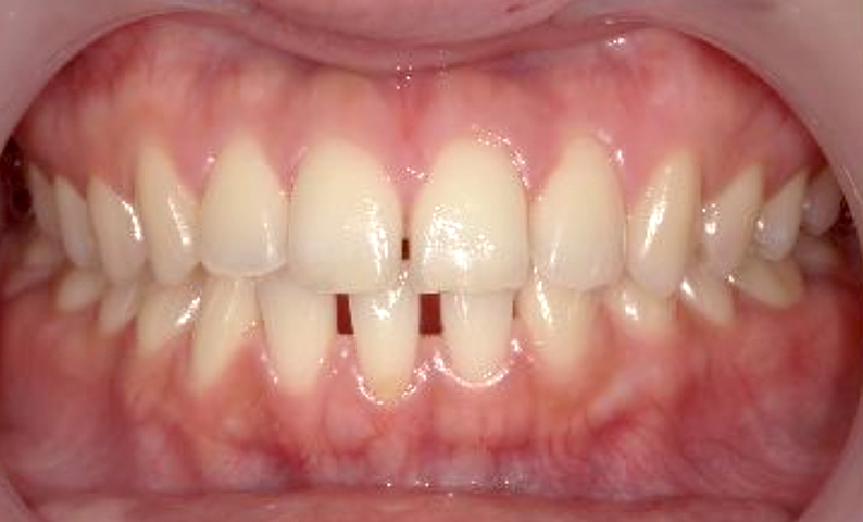 部分矯正すきっ歯の症例写真