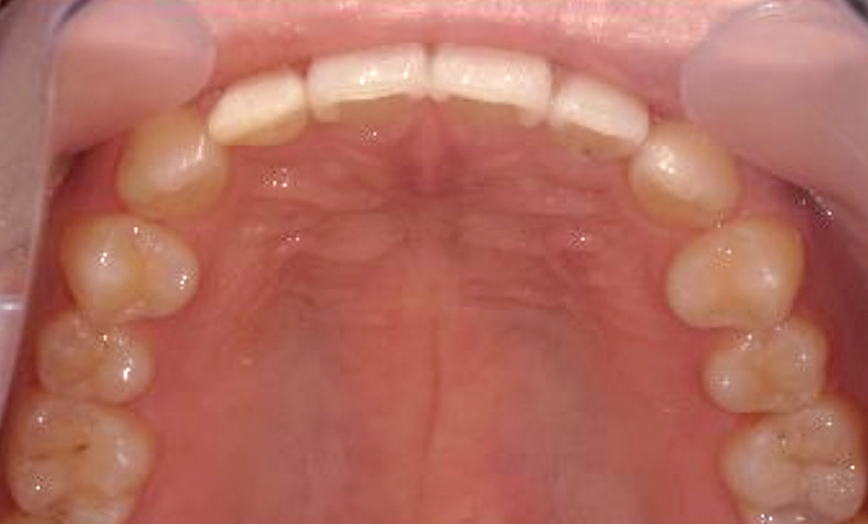 部分矯正 すきっ歯の症例写真