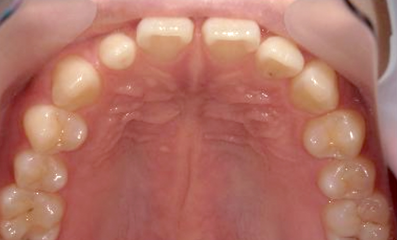 部分矯正 すきっ歯の症例写真