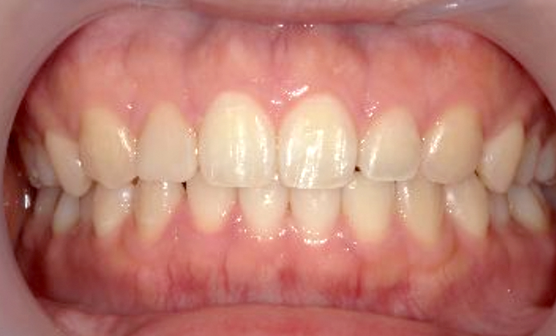 部分矯正 すきっ歯の症例写真