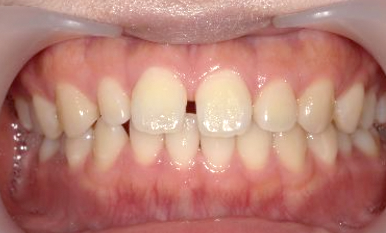 部分矯正 すきっ歯の症例写真