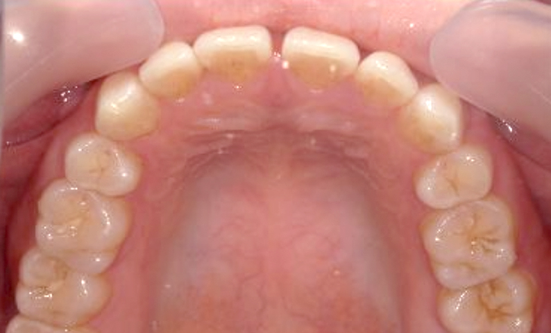 部分矯正 すきっ歯の症例写真