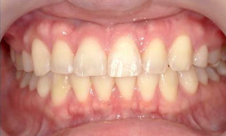 部分矯正 すきっ歯の症例写真
