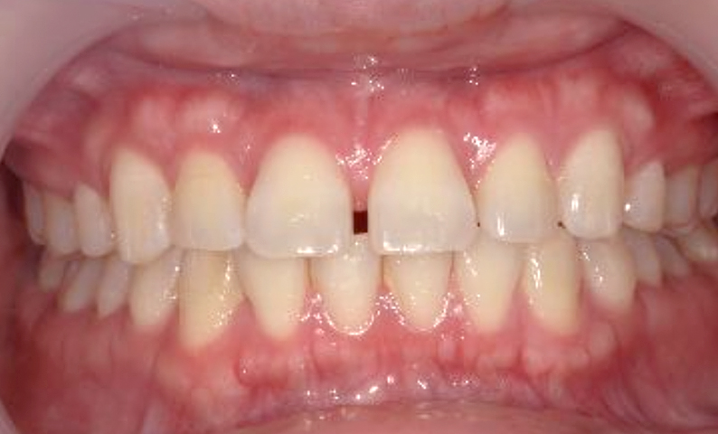 部分矯正 すきっ歯の症例写真