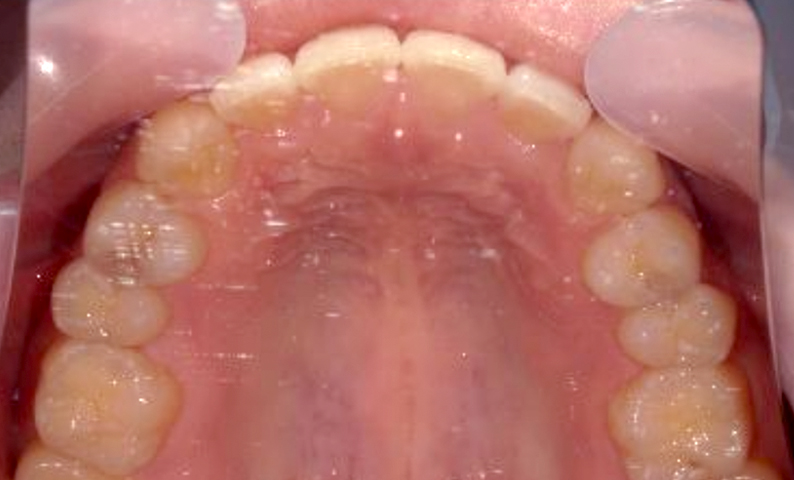 部分矯正 すきっ歯の症例写真