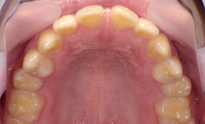 部分矯正 すきっ歯の症例写真