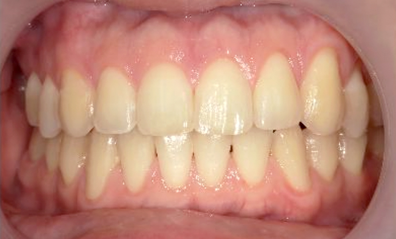 部分矯正 すきっ歯の症例写真