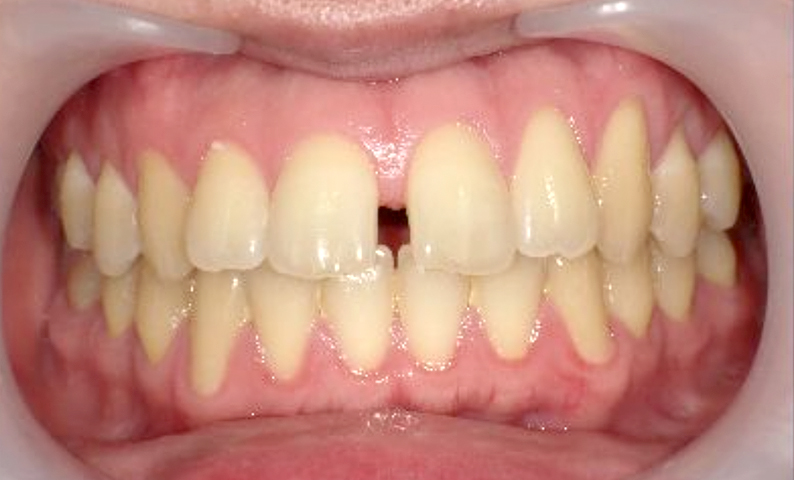 部分矯正 すきっ歯の症例写真
