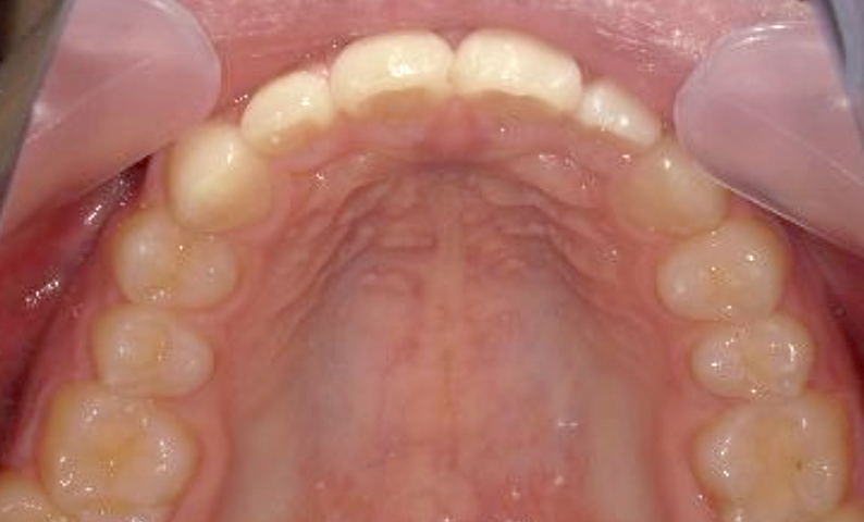 部分矯正 すきっ歯の症例写真