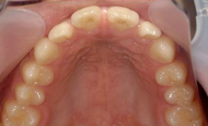 部分矯正 すきっ歯の症例写真