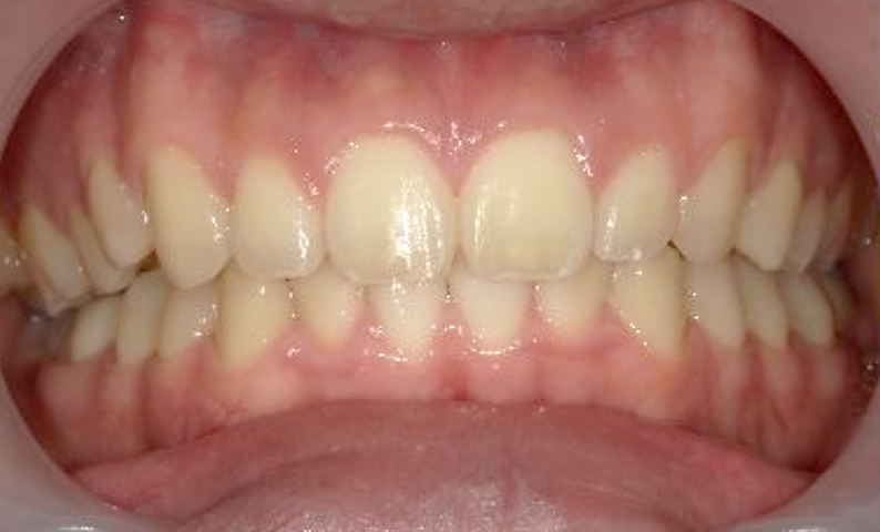 部分矯正 すきっ歯の症例写真