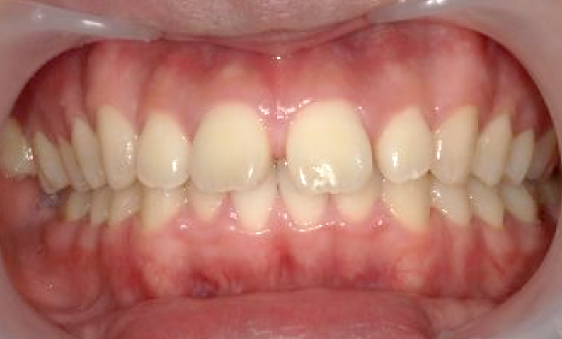 部分矯正 すきっ歯の症例写真