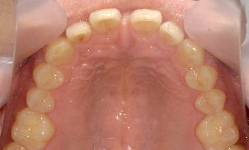 部分矯正 すきっ歯の症例写真