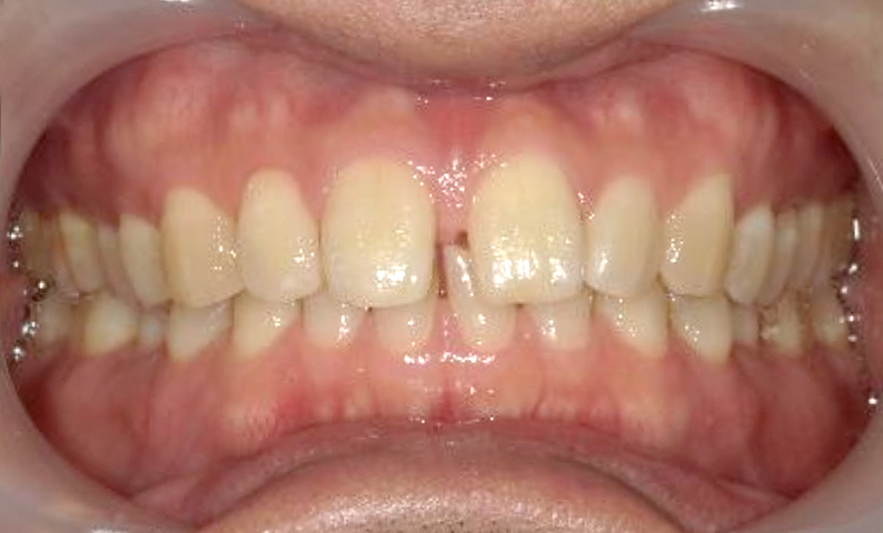 部分矯正 すきっ歯の症例写真