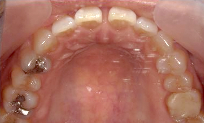 部分矯正 すきっ歯の症例写真