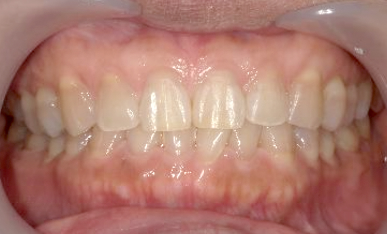 部分矯正 すきっ歯の症例写真