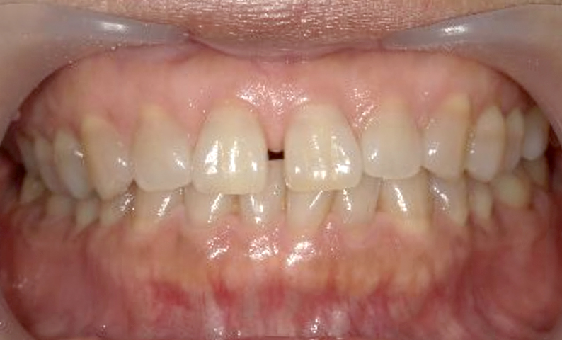 部分矯正 すきっ歯の症例写真