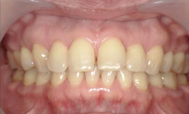 部分矯正 すきっ歯の症例写真