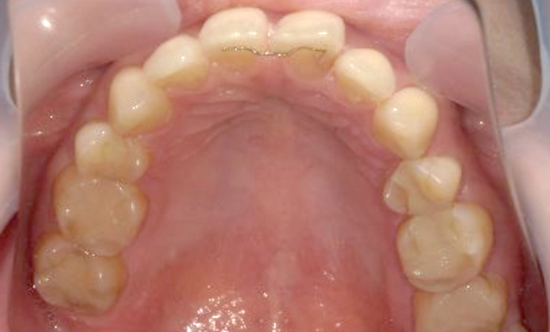 部分矯正 すきっ歯の症例写真