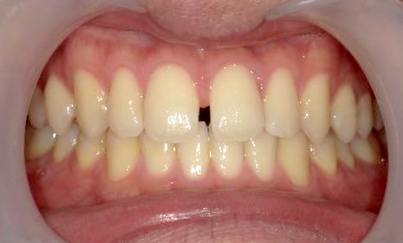 部分矯正 すきっ歯の症例写真