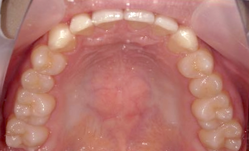 部分矯正 すきっ歯の症例写真