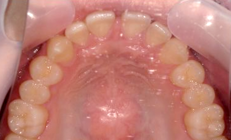 部分矯正 すきっ歯の症例写真