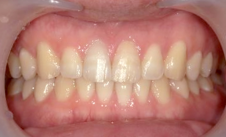 部分矯正 すきっ歯の症例写真