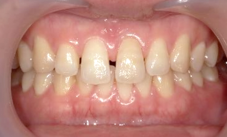 部分矯正 すきっ歯の症例写真