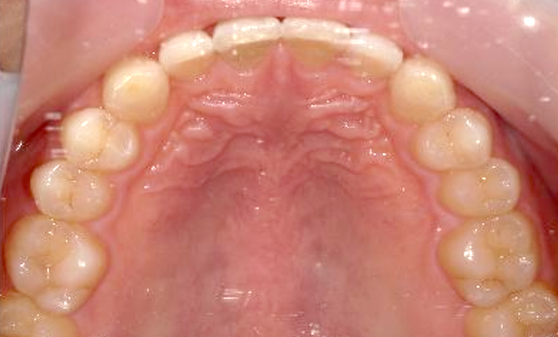 部分矯正 すきっ歯の症例写真