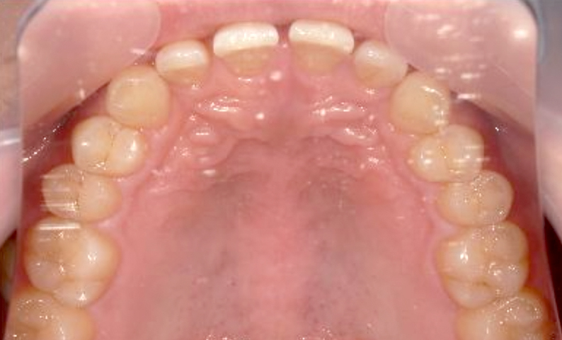 部分矯正 すきっ歯の症例写真