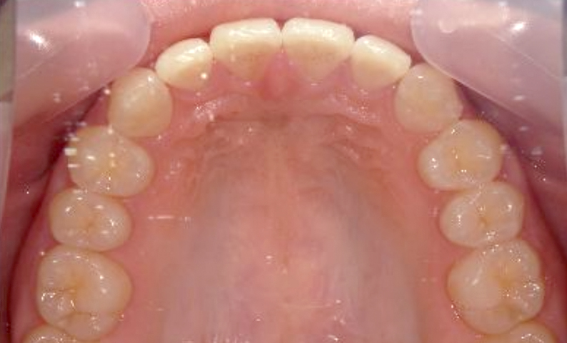 部分矯正すきっ歯の症例写真