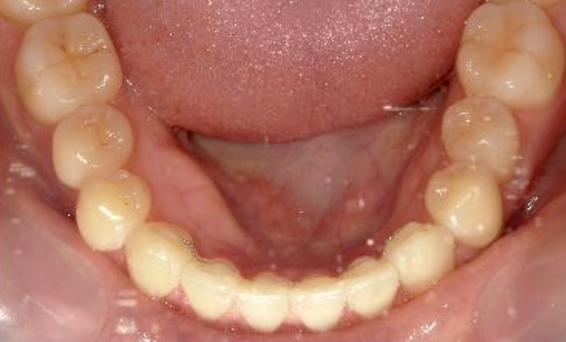 部分矯正すきっ歯の症例写真