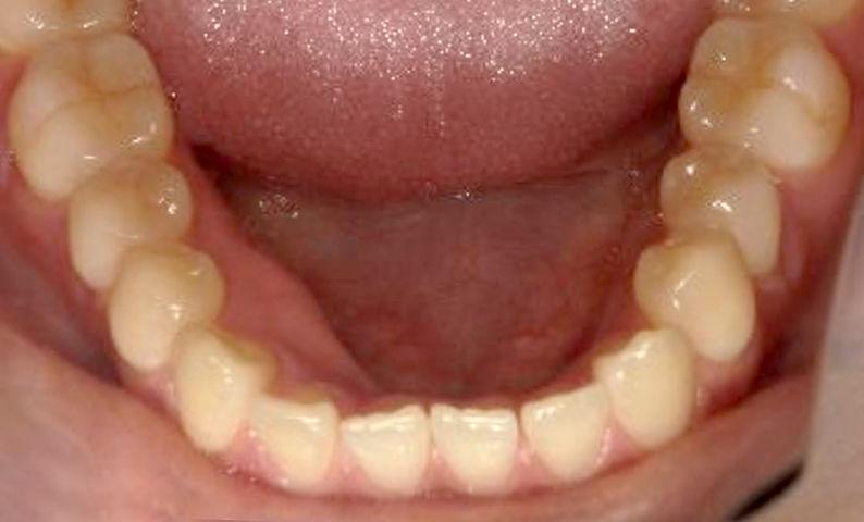 部分矯正すきっ歯の症例写真