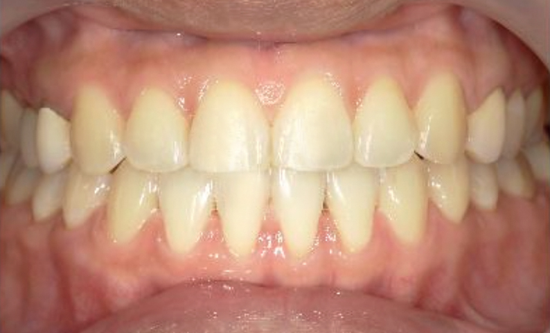 部分矯正すきっ歯の症例写真