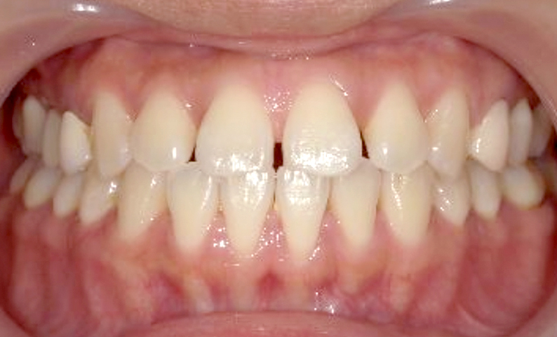 部分矯正すきっ歯の症例写真