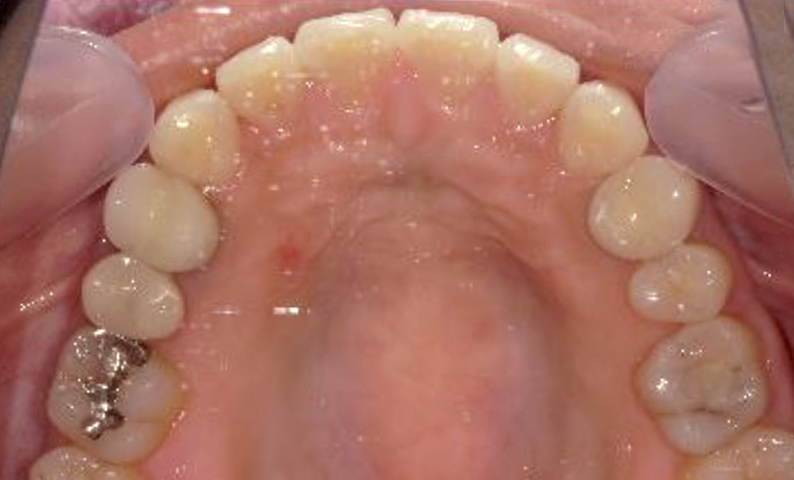 部分矯正すきっ歯の症例写真