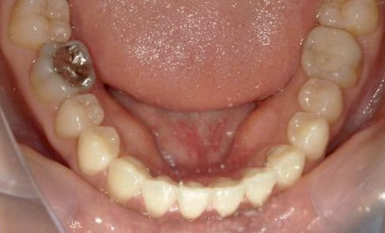 部分矯正すきっ歯の症例写真