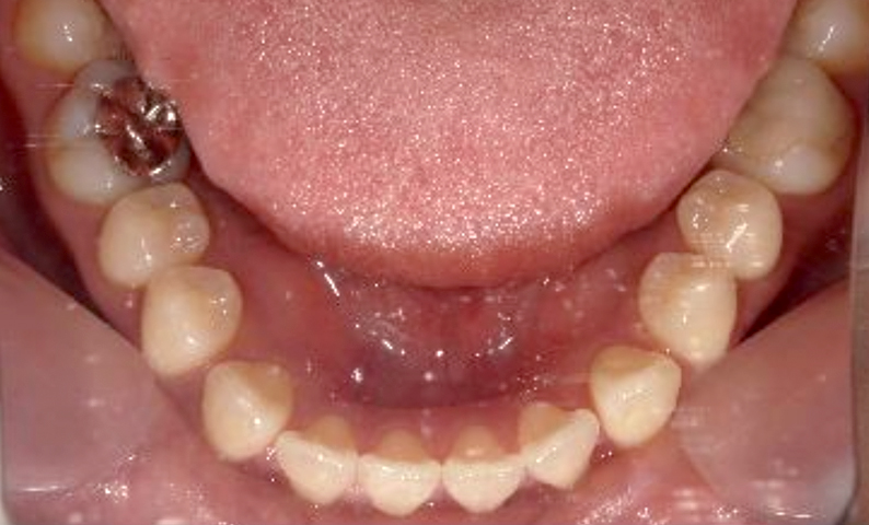 部分矯正すきっ歯の症例写真