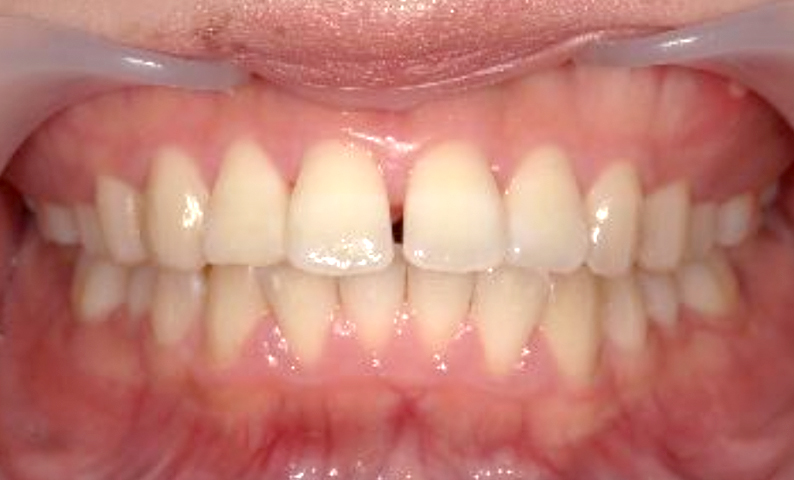 部分矯正 すきっ歯の症例写真