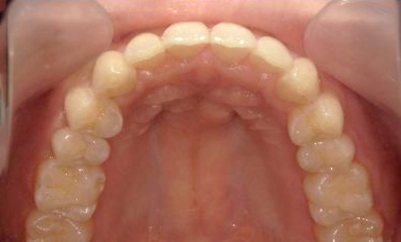 部分矯正 すきっ歯の症例写真