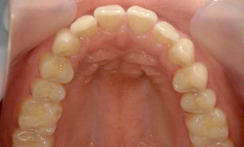 部分矯正 すきっ歯の症例写真