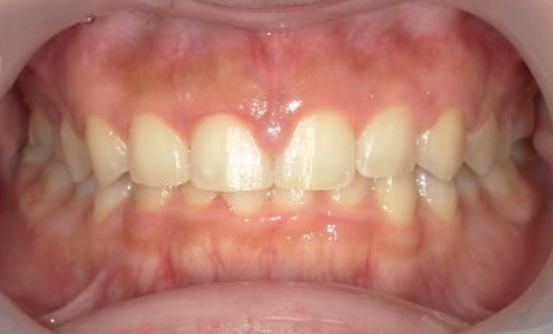 部分矯正 すきっ歯の症例写真