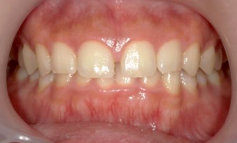 部分矯正 すきっ歯の症例写真