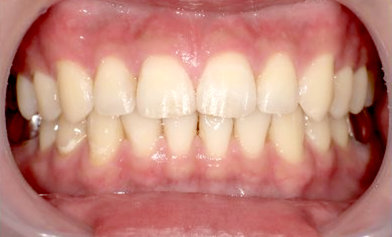 部分矯正 すきっ歯の症例写真