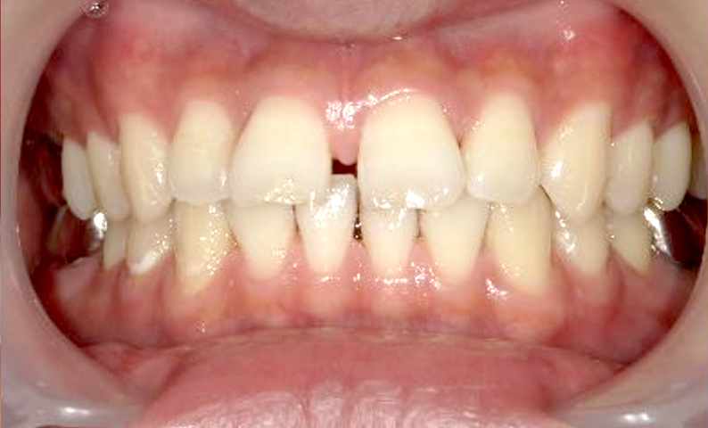 部分矯正 すきっ歯の症例写真