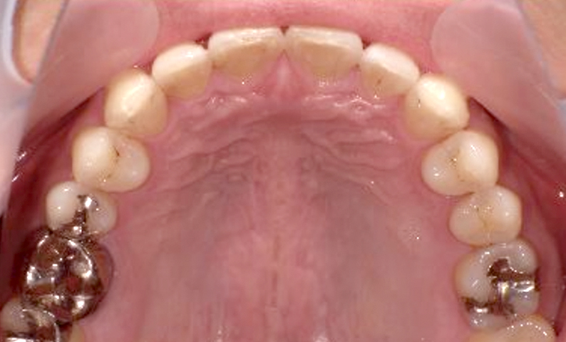 部分矯正 すきっ歯の症例写真