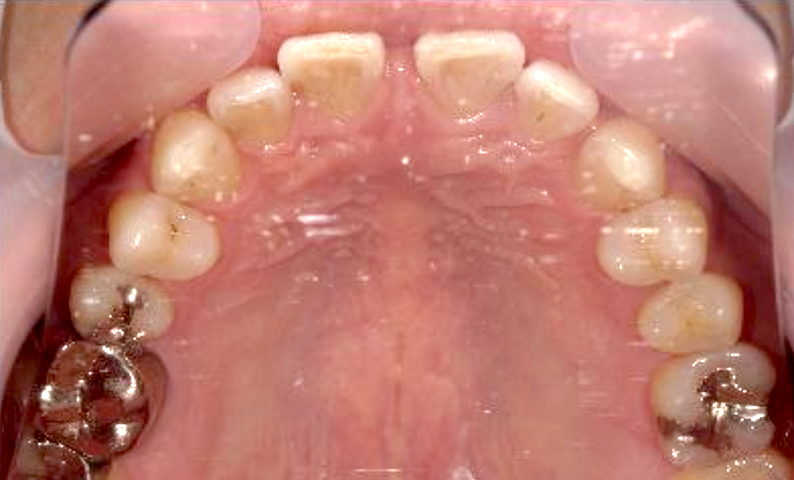 部分矯正 すきっ歯の症例写真